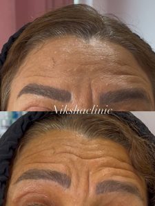تزریق بوتاکس