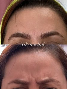 تزریق بوتاکس