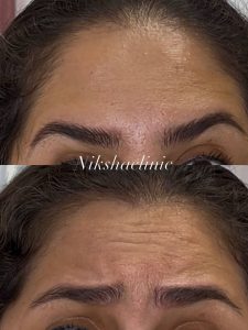 تزریق بوتاکس