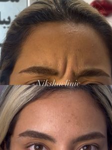 تزریق بوتاکس