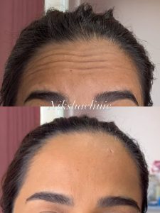 تزریق بوتاکس